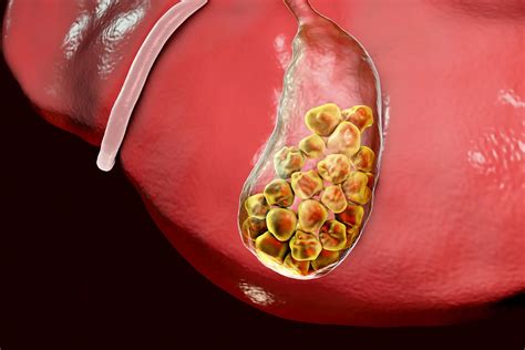 Gallstones (Cholelithiasis): Symptoms, Causes, and Treatments