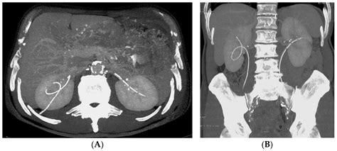 Complications Subsequent to Urinary Tract Stent Placement: An Overview Focusing on the Imaging ...
