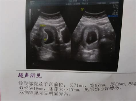 孕12周胎儿小鸡彩超图男孩_知秀网