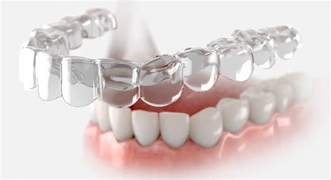 Premium Invisalign Treatment & Braces Treatment - Finedent