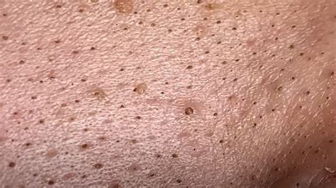 Image result for Worst Exploding Pimple