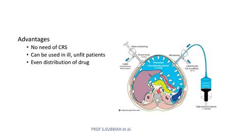 Image result for Intraperitoneal Injection Ovarian Cancer