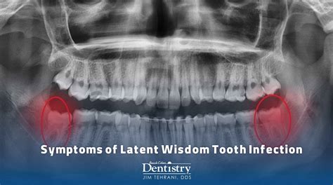 Wisdom Tooth Infection Symptoms Gum Flap Over Wisdom Tooth? Everything