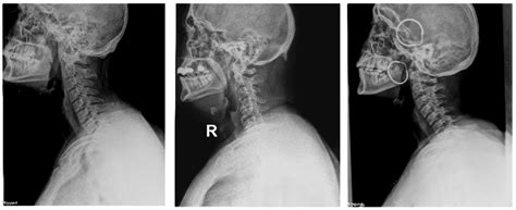 Classification of Cervical Spine Fracture and Dislocation Using Refined ...