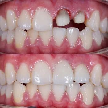 Best Dental Crowns & Bridges in Tirupati | Zirconia