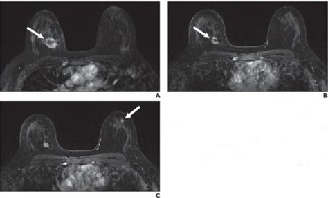 New suspicious lesions on breast MRI in neoadjuvant therapy not malignant
