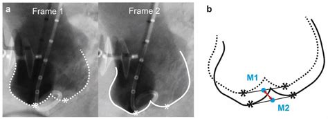 Nonsurgical Repair of the Ascending Aorta: Why Less Is More