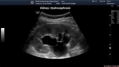 Hydronephrosis [1 image] – EFSUMB