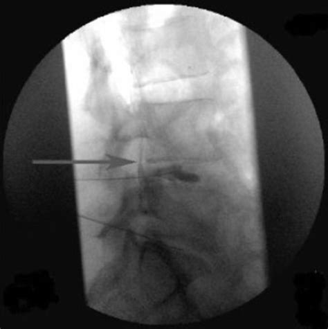 Image result for Fluoro Spinal Injection