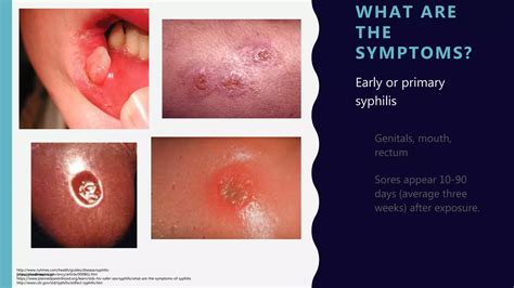 Image result for Syphilis Algorithm Exposure