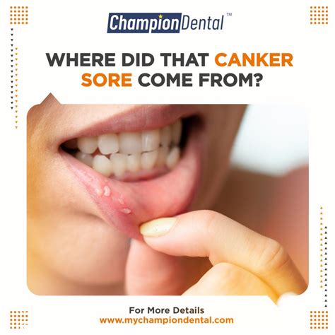Common Causes of Canker Sores in Mouth - Champion Dental