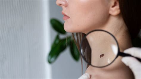 What causes skin tags and how to remove them