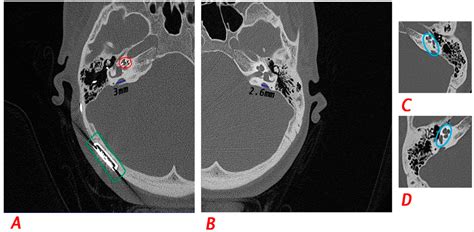 SLC26A4 Phenotypic Variability Influences Intra- and Inter-Familial ...