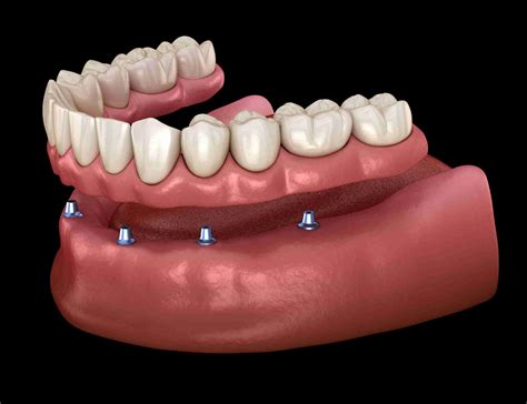 Loose Fitting Dentures – Straits Area Dental