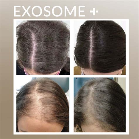 EXOSOME HAIR LOSS - Dr.Prinou