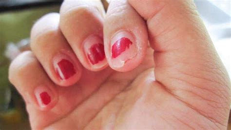 Brittle Nails: Causes, Symptoms, Treatment and Home Remedies | Femina.in