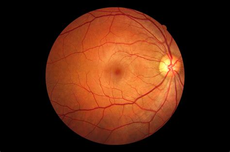 Desprendimiento de Retina: Causas, síntomas y tratamiento - Urgencias
