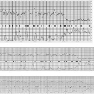 Pseudosinusoidal pattern. External fetal heart rate monitoring at 1 ...
