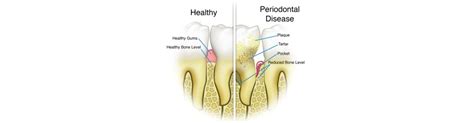 Hyderabad Dental Hospital » Periodontics