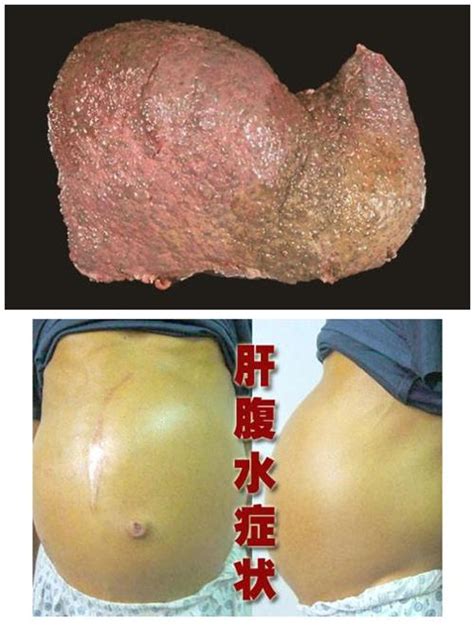 酒精性肝硬化传染吗酒精肝硬化能治好吗2022已更新今日动态