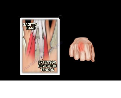 Sagittal Band Injury — OrthopaedicPrinciples.com