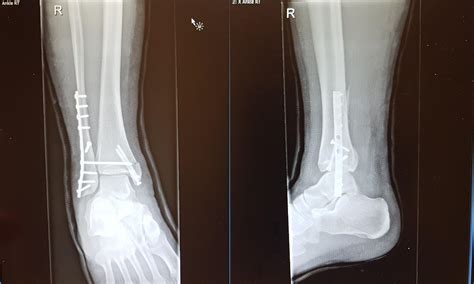 Xray Of Broken Ankle Leg Fracture, X Ray Stock Image C026/7918