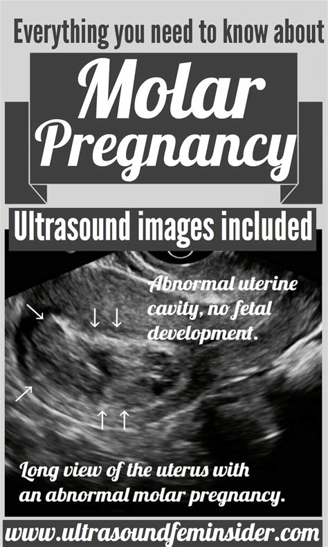 Molar pregnancy information ultrasound included – Artofit