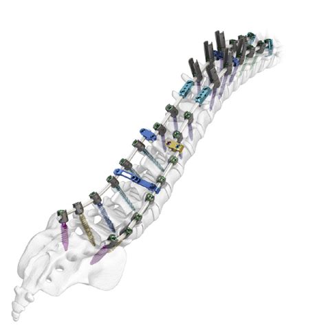 Image result for Spinal Fixation