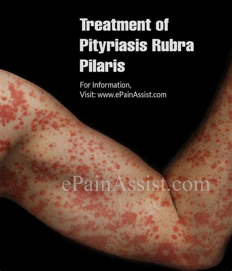 What is Pityriasis Rubra Pilaris|Types|Causes|Symptoms|Treatment|Prevention