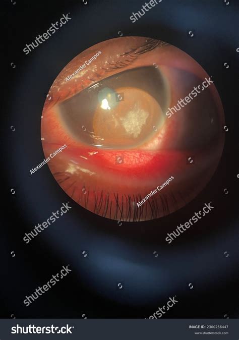 Corneal Ulcer