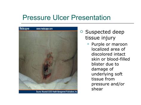 Pressure ulcer presentation3 | PPT