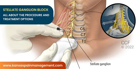 Stellate Ganglion Stellate Ganglion Block Kenner, LA & Metairie, LA: