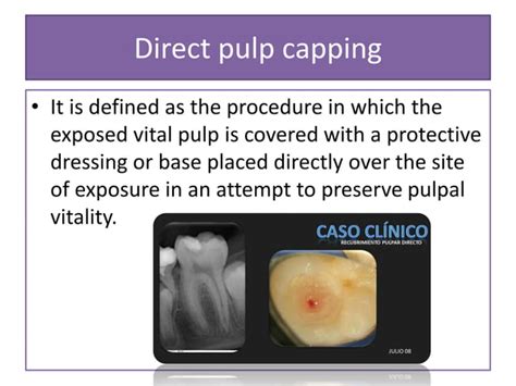 Image result for Difference Between Direct and Indirect Pulp Capping