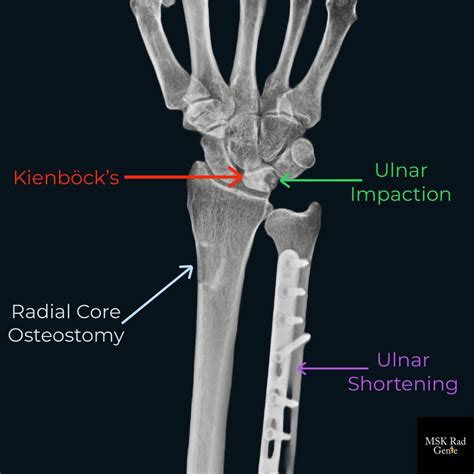 Ulnar Impaction Syndrome