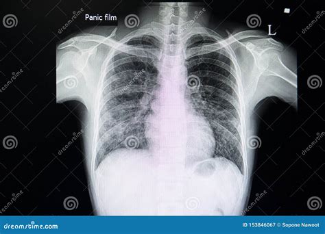 Interstitial Pneumonia X Ray
