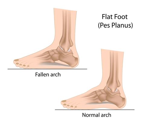 Foot Pain Caused by Flat Feet Can Be Treated | Healthmark Foot & Ankle Associates