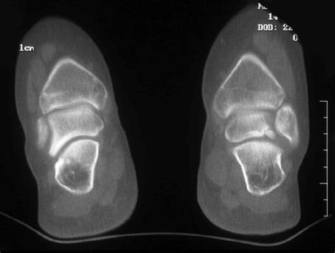 Osteochondritis Dissecans of the Talus Involving the Subtalar Joint: A ...