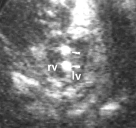 Dystrophic calcification of the fetal myocardium | Heart