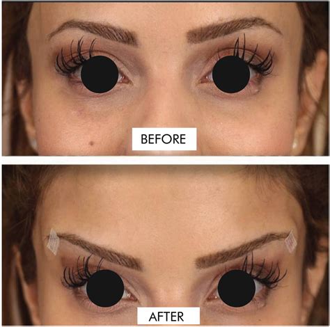 Image result for Thread Brow Lift Procedure