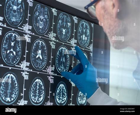 Scientist viewing a patient's brain MRI (magnetic resonance imaging) scan for ageing and damage ...