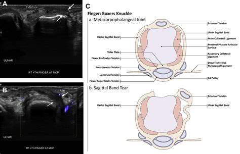 Imaging of Sports Injuries of the Upper Extremity - Advances in ...