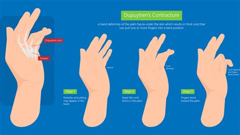 Dupuytren's Contracture Treatments