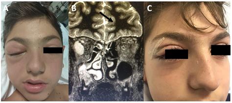 Sinonasal-Related Orbital Infections in Children: A Clinical and ...