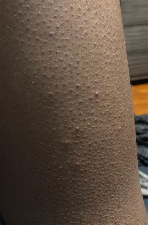 [Acne] sudden red raised bumps on thigh : r/SkincareAddiction