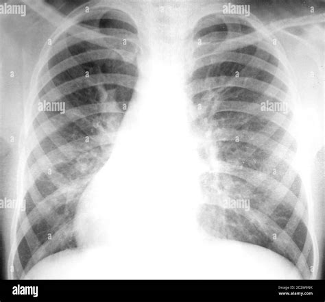 Hospital X-ray Chest 的图像结果