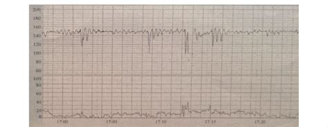 Fetal heart rate sinusoidal pattern - part I. | Download Scientific Diagram
