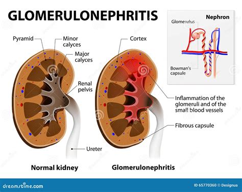 Glomerulonephritis Or Glomerular Nephritis. Kidney Disease Vector Illustration | CartoonDealer ...
