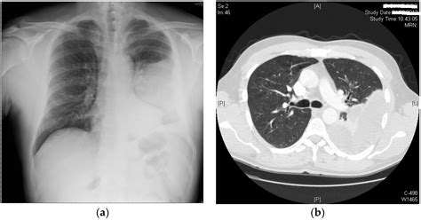 Pleural Effusion Chest X Ray
