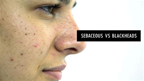 Sebaceous Filaments vs Blackheads A Clear Guide to Your Pores – Neutralyze