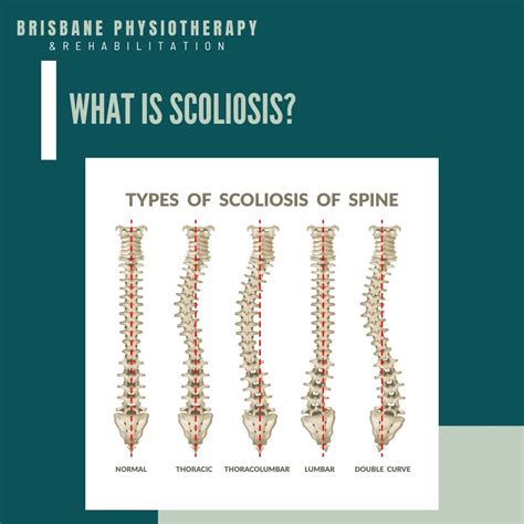 What is Scoliosis? - Brisbane Physiotherapy & Podiatry